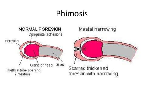 Image:Phimosis